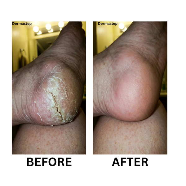 Closed my deep cracks in 1 week!