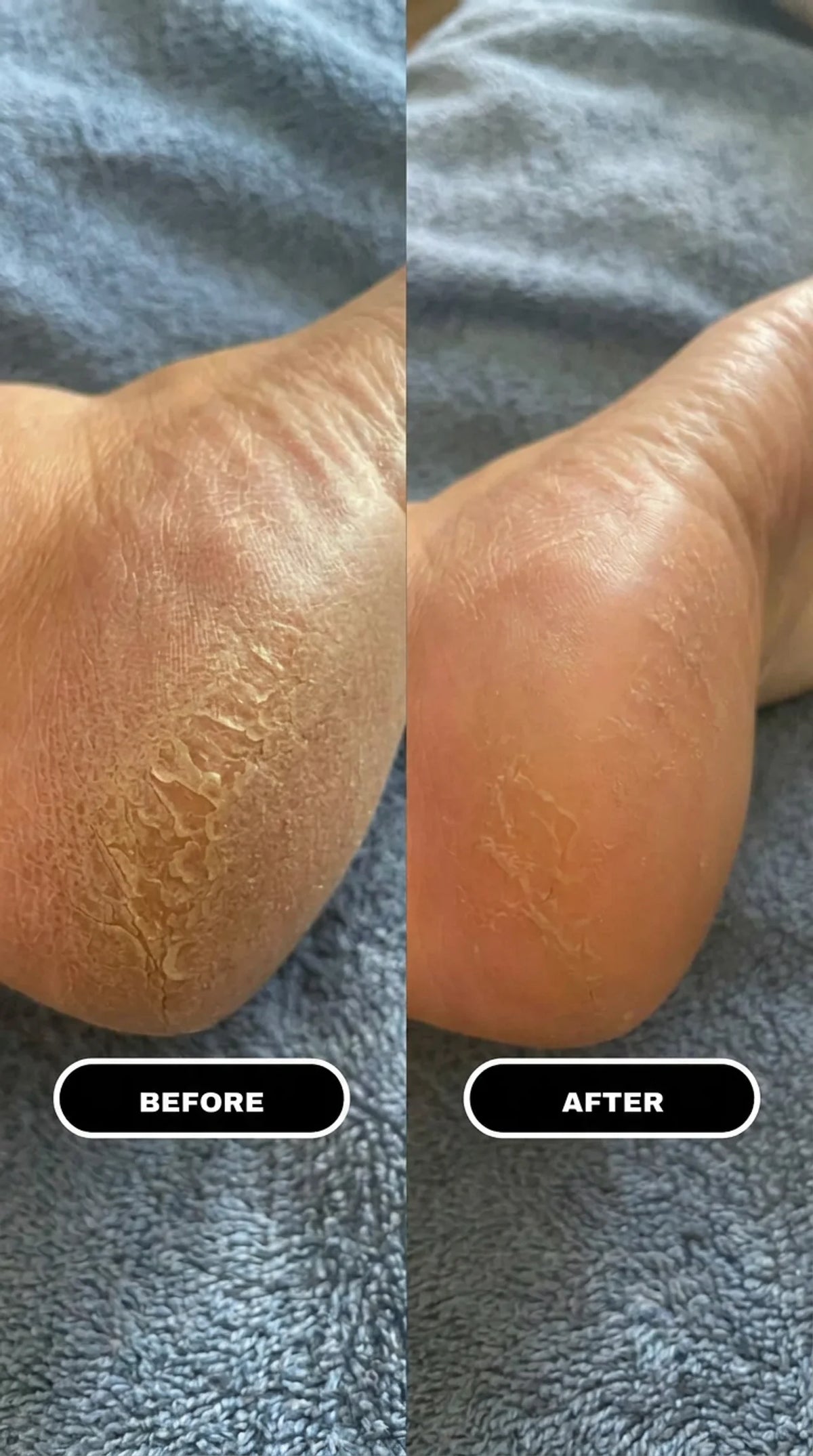 Dermastep Overnight Heel Balm— 60% Urea Balm for Dry, Cracked Heels