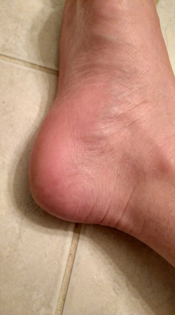 No more painful walking!