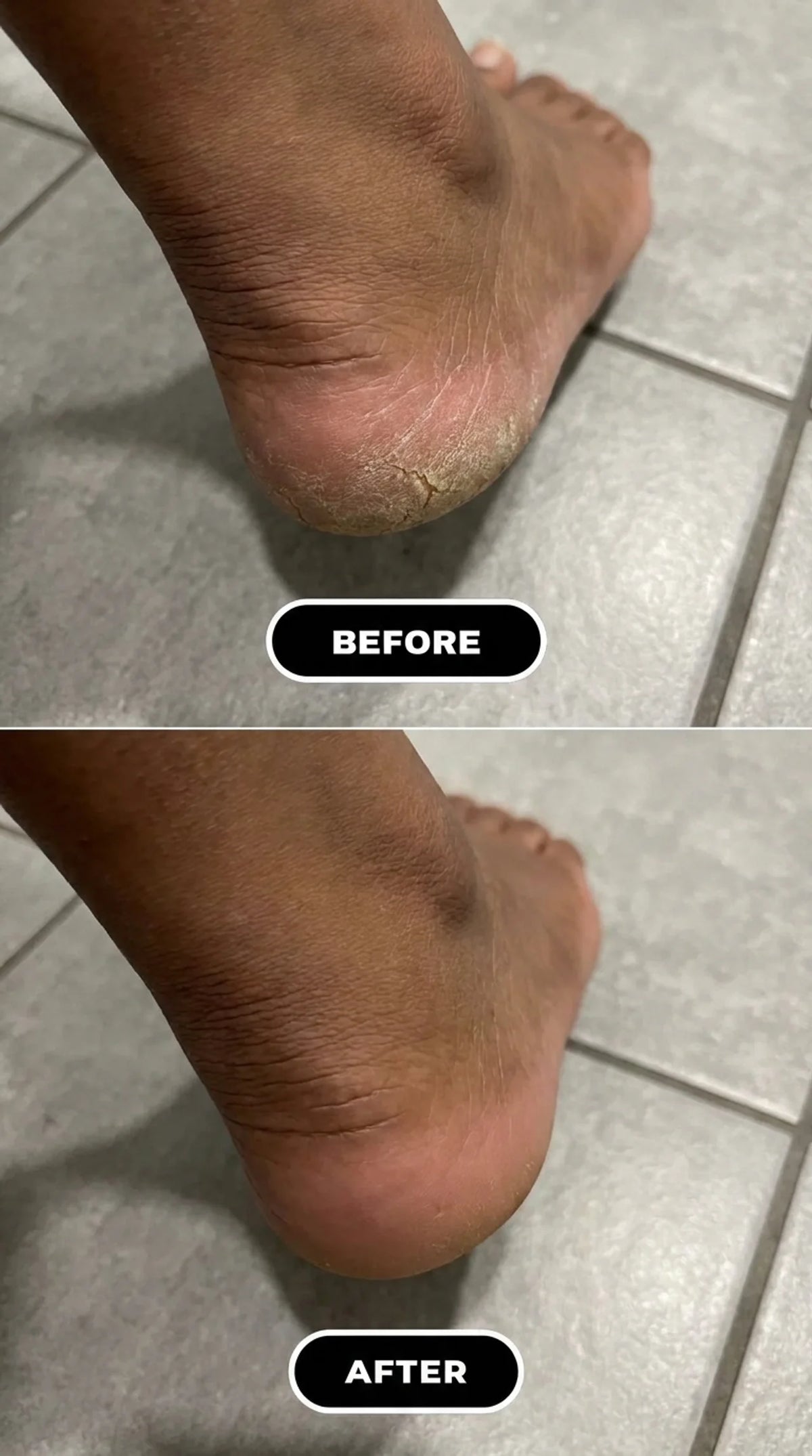 Dermastep Overnight Heel Balm— 60% Urea Balm for Dry, Cracked Heels